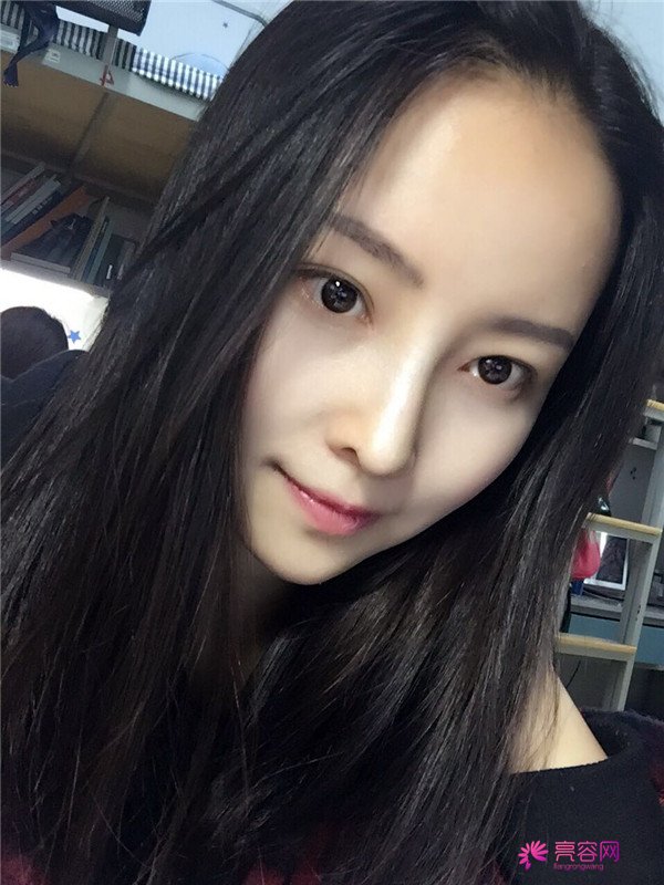 我来和大家分享我的隆鼻日记了,我自己恢复得不错,所以放心大胆的将自己的鼻子交给医院啦~