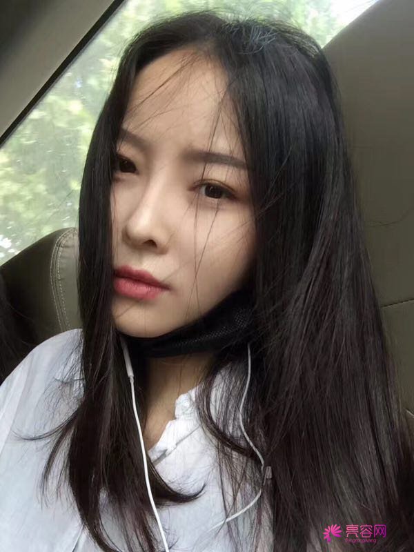 我来和大家分享我的隆鼻日记了,我自己恢复得不错,所以放心大胆的将自己的鼻子交给医院啦~