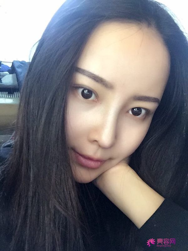 我来和大家分享我的隆鼻日记了,我自己恢复得不错,所以放心大胆的将自己的鼻子交给医院啦~
