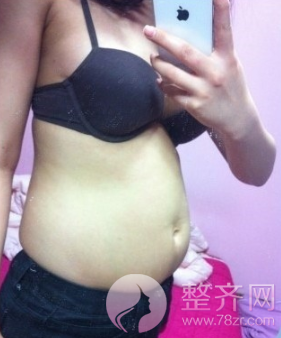 南京腰腹吸脂术后恢复过程