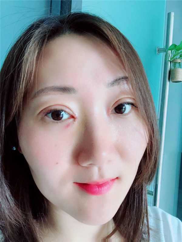 苏州美莱张亮割双眼皮案例分享附双眼皮一般多少钱?