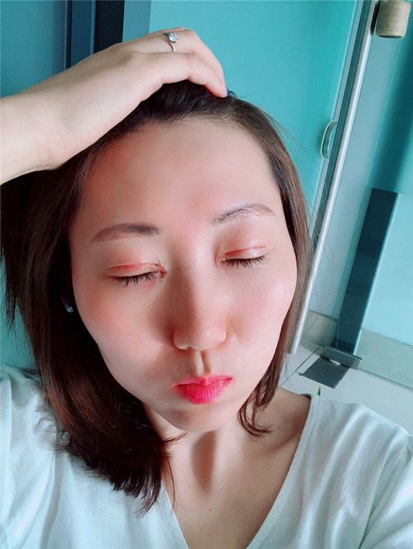 苏州美莱张亮割双眼皮案例分享附双眼皮一般多少钱?