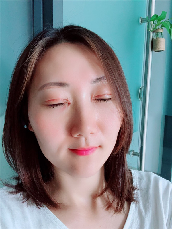 苏州美莱张亮割双眼皮案例分享附双眼皮一般多少钱?