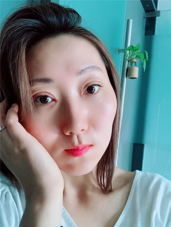 苏州美莱张亮割双眼皮案例分享附双眼皮一般多少钱?