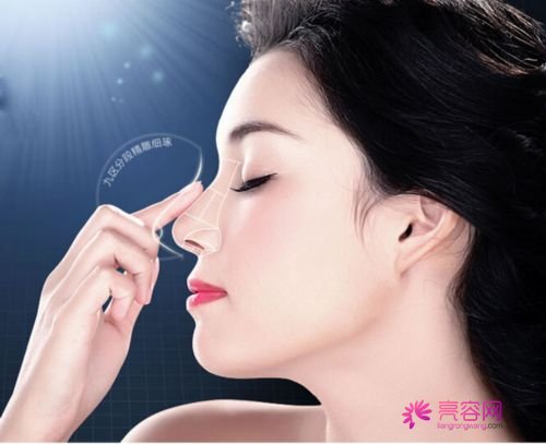 深圳希思隆鼻怎么样?价格案例分享