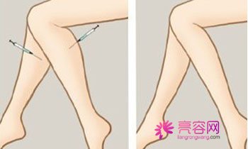 太原时光吸脂怎么样?价格案例分享