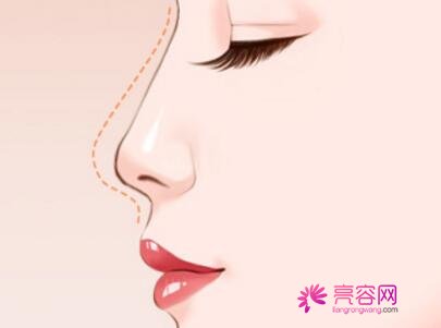 南昌爱思特隆鼻怎么样?价格案例分享