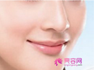 北京薇琳隆鼻怎么样?价格案例分享