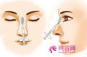石家庄雅芳亚隆鼻怎么样?价格案例分享