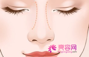 北京京民王志坚隆鼻怎么样?价格案例分享