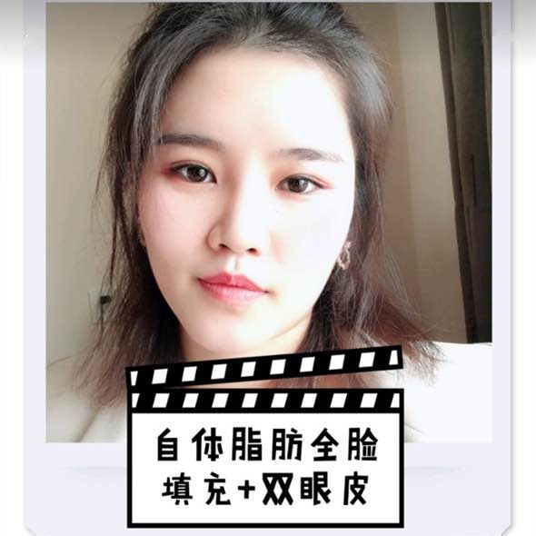 广州宸山医美做的双眼皮＋自体脂肪填充