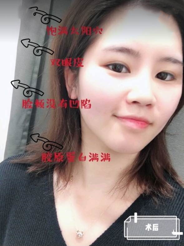 广州宸山医美做的双眼皮＋自体脂肪填充