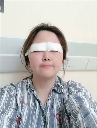 上海九院,张盈帆,双眼皮,案例,价格,