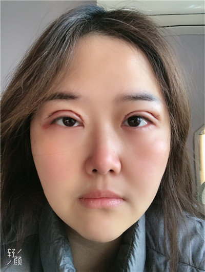 上海九院,张盈帆,双眼皮,案例,价格,