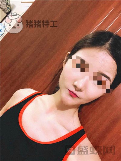 福州美贝尔，原上海九院，赵栋材，面部填充，案例，价格，