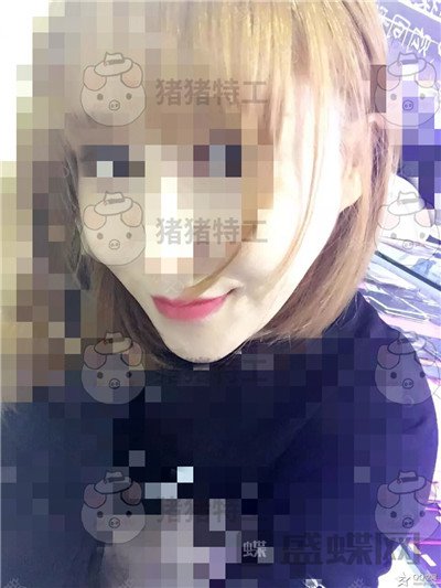 北京八大处，解芳，下巴截骨，案例，价格，