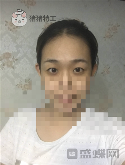 杭州美莱,韩超,双眼皮,案例,价格,