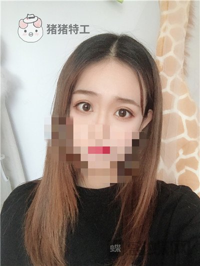 杭州美莱,韩超,双眼皮,案例,价格,