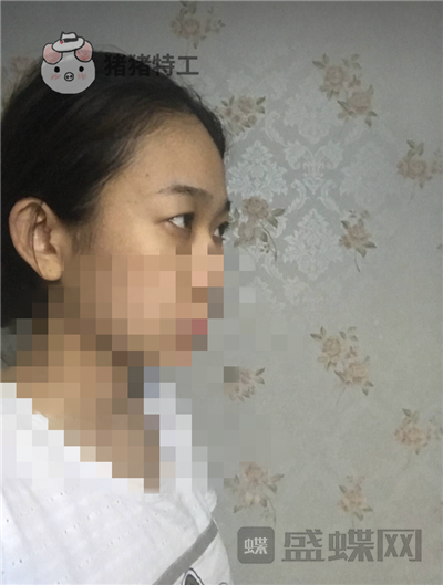 杭州美莱,韩超,双眼皮,案例,价格,