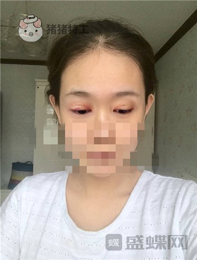 杭州美莱,韩超,双眼皮,案例,价格,