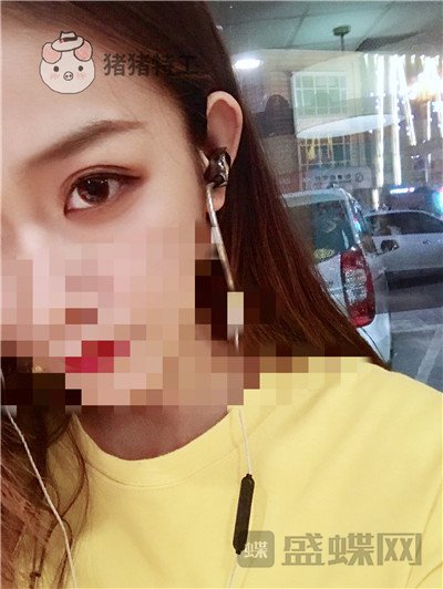 杭州美莱,韩超,双眼皮,案例,价格,