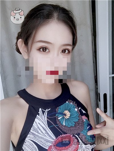 杭州美莱,韩超,双眼皮,案例,价格,