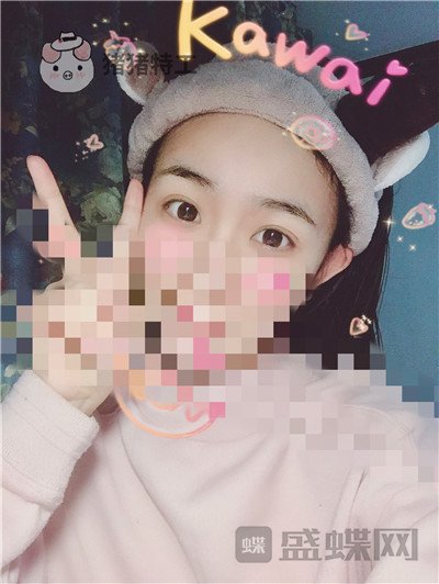 杭州美莱,韩超,双眼皮,案例,价格,