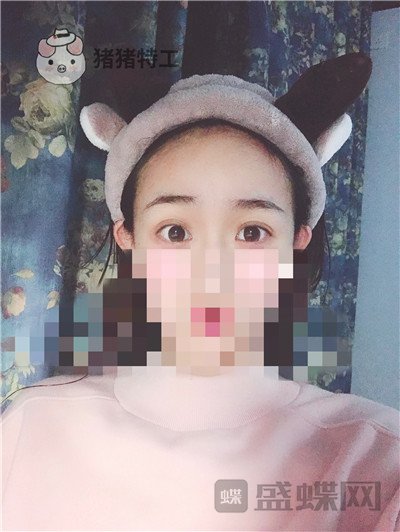 杭州美莱,韩超,双眼皮,案例,价格,
