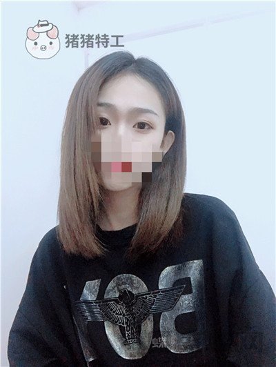 杭州美莱,韩超,双眼皮,案例,价格,