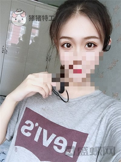 杭州美莱,韩超,双眼皮,案例,价格,
