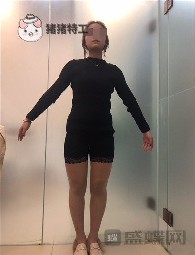 昆明梦想整形李成龙吸脂案例价格分享，小象腿到筷子腿的蜕变~