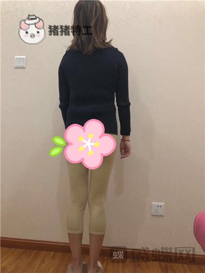 昆明梦想整形李成龙吸脂案例价格分享，小象腿到筷子腿的蜕变~