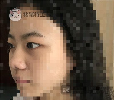 上海百达丽,周珍艳,双眼皮,,案例,价格,