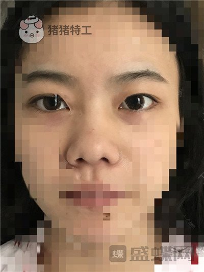 上海百达丽,周珍艳,双眼皮,,案例,价格,