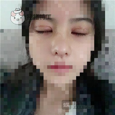 上海百达丽,周珍艳,双眼皮,,案例,价格,