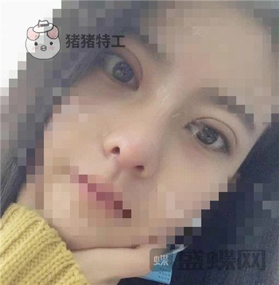 上海百达丽,周珍艳,双眼皮,,案例,价格,