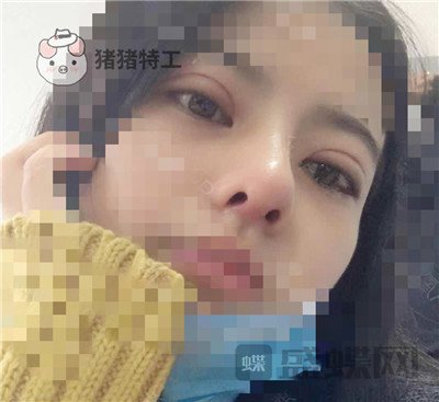 上海百达丽,周珍艳,双眼皮,,案例,价格,