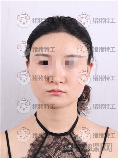 上海华美,李志海,下颌角整形,案例,价格,