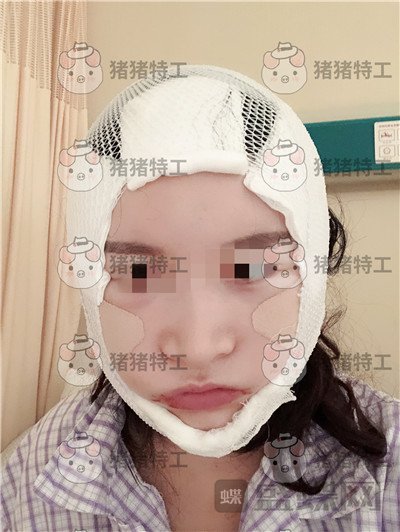 上海华美,李志海,下颌角整形,案例,价格,