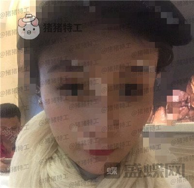 上海华美,李志海,下颌角整形,案例,价格,