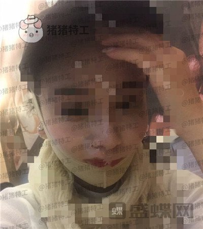 上海华美,李志海,下颌角整形,案例,价格,