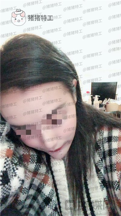 上海华美,李志海,下颌角整形,案例,价格,