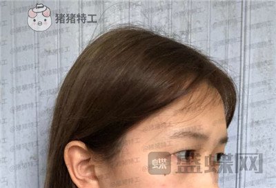 广东画美,牟北平,双眼皮,案例,价格,