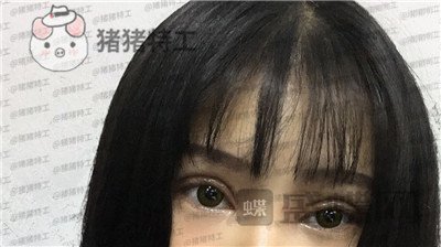 西安高一生,刘军,双眼皮,案例,价格,