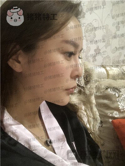 重庆铂生,杜亚旭,隆鼻,案例,价格,