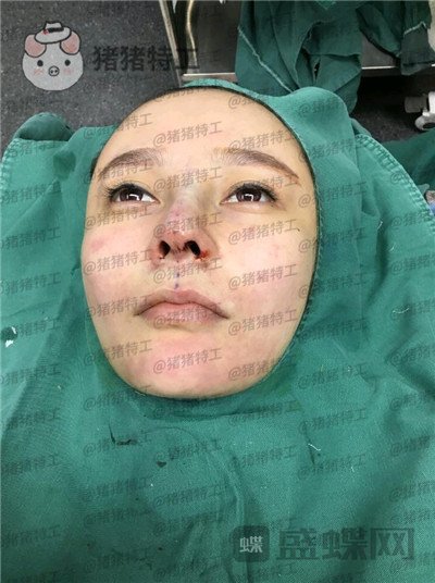 重庆铂生,杜亚旭,隆鼻,案例,价格,