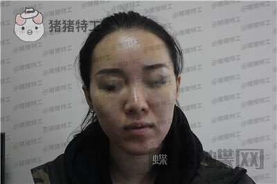 成都西区医院,车红昌,,案例,价格,