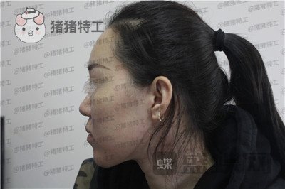 成都西区医院,车红昌,,案例,价格,