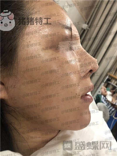 成都西区医院,车红昌,,案例,价格,