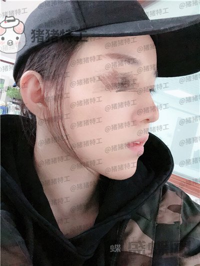 成都西区医院,车红昌,,案例,价格,